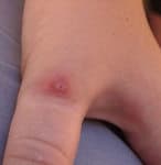 Tarantula bite